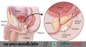 প্রোস্টেট ক্যান্সার